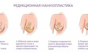 Сколько стоит пластика груди: особенности операции и советы врачей