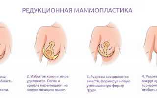 Сколько стоит пластика груди: особенности операции и советы врачей
