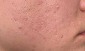 Как избавиться от красных пятен от прыщей – полезные советы