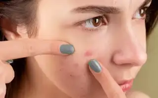 Как быстро убрать красные пятна от прыщей – действенные рецепты