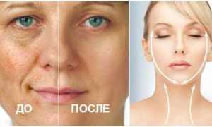 Яблочный уксус для лица, в чем его польза?