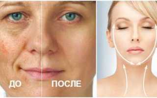 Яблочный уксус для лица, в чем его польза?